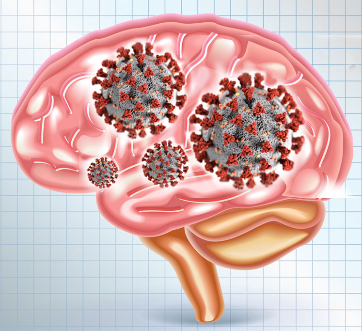 코로나바이러스 팬데믹, 뇌손상도 일으킬 수 있다는 과학자들의 경고